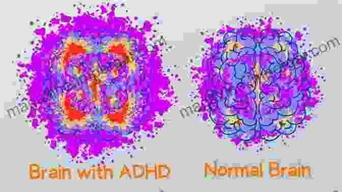 A Brain Scan Showing The Differences In Activity Between Individuals With And Without ADHD The Elephant In The ADHD Room: Beating Boredom As The Secret To Managing ADHD