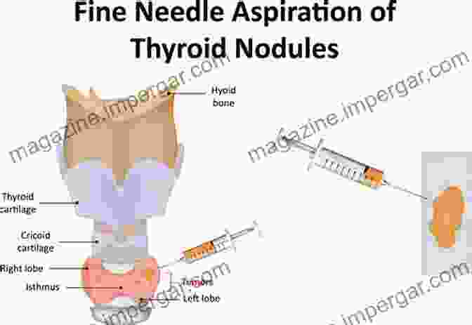 Aspirating Cells From A Thyroid Nodule Using FNA Fine Needle Aspiration Of Bone Tumours: The Clinical Radiological Cytological Approach (Monographs In Clinical Cytology Vol 19)