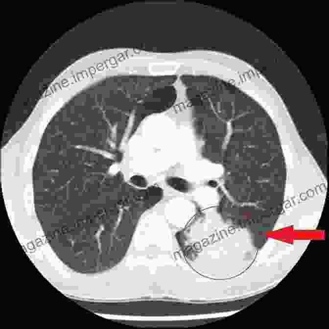 CT Scan Image Of A Lung Nodule Fine Needle Aspiration Of Bone Tumours: The Clinical Radiological Cytological Approach (Monographs In Clinical Cytology Vol 19)