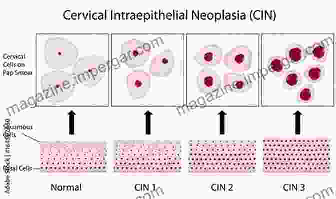 Pap Smear Showing Abnormal Cells Indicative Of Cervical Cancer Fine Needle Aspiration Of Bone Tumours: The Clinical Radiological Cytological Approach (Monographs In Clinical Cytology Vol 19)