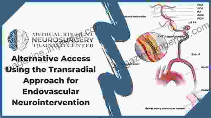 Radial Access For Neurointervention: Comprehensive Guide Radial Access For Neurointervention