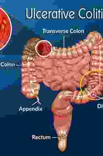 Ulcerative Colitis (Updates In Surgery)