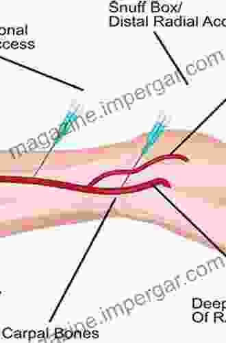 Radial Access For Neurointervention